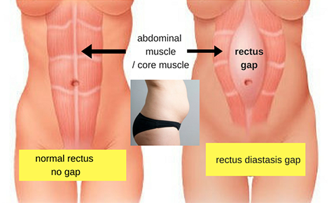 shapewear can help repair the rectus abdomen.